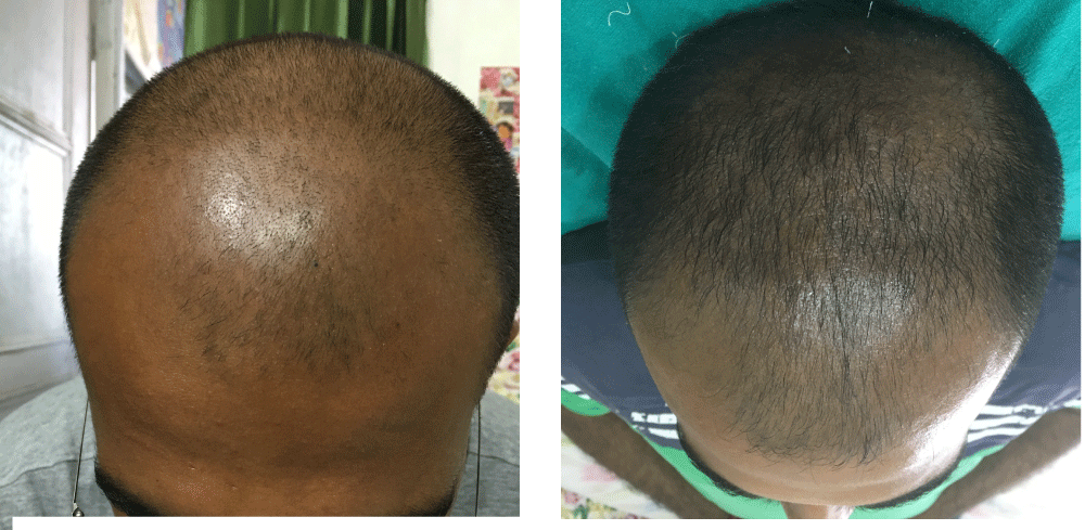 A study on the efficacy of microneedling with minoxidil solution versus  microneedling with hair multivitamin solution for the treatment of  androgenetic alopecia