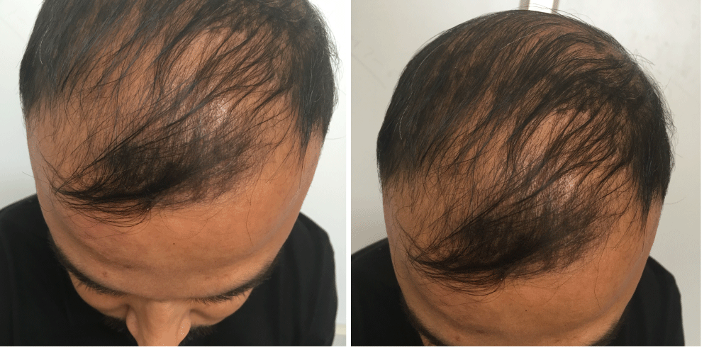 A study on the efficacy of microneedling with minoxidil solution versus  microneedling with hair multivitamin solution for the treatment of  androgenetic alopecia