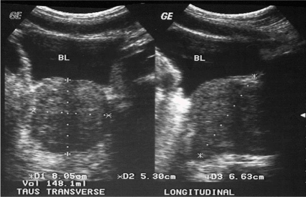 normal prostate volume ultrasound radiology)