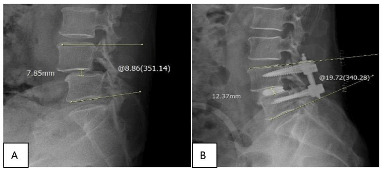 Lumbar Spine Collapse: A Case Study
